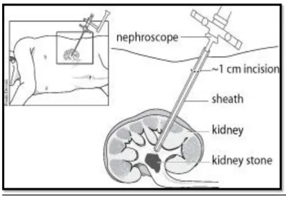 Figure 3 - PCNL (taken from www.uroinfo.ca) 