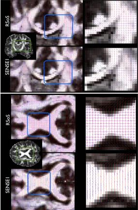 Figure 3.Fibre orientations estimated using the ball & stick model on RSoS and SENSE1