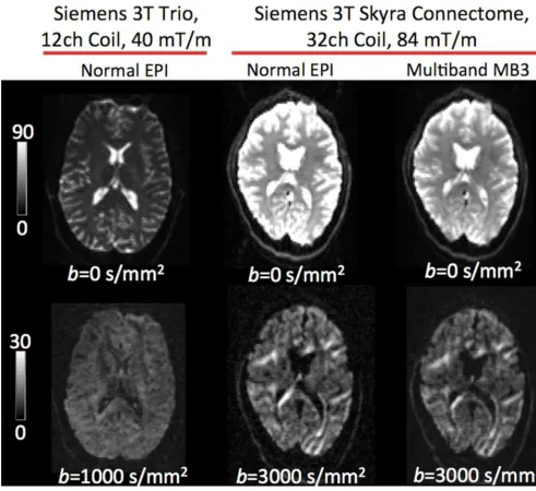 Figure 1.Representative examples of dMRI with a Siemens Trio and the Connectome Skyra (not