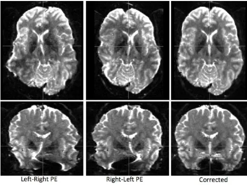 Figure 6.Correction of susceptibility-induced distortions using pairs of phase encoding (PE)-reversed
