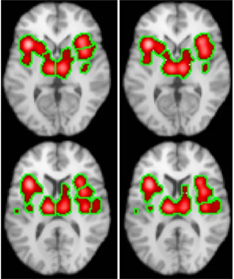 Figure 7. Clusters obtained with the pain data using theclustering algorithm described in appendix S1 (left), and alsousing a simplified algorithm that ignores the ALE (right)