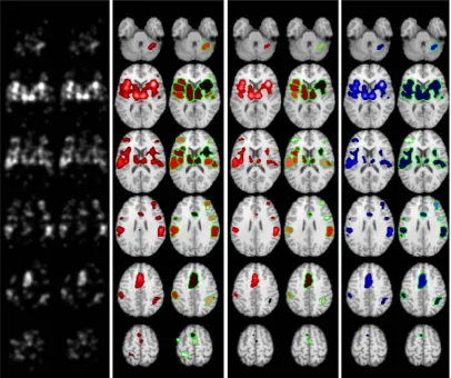 Figure 6. ALE images and statistically significant clusters found on meta-analysis of the thermal pain stimulus data using LocalALE(red) and GingerALE (blue).Column 2 shows results using FDR control, and column 3 FCDR control