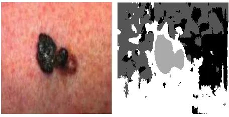Figure 2 Example of clustering with 4 clusters a) original Skin-3 image b) clustered image