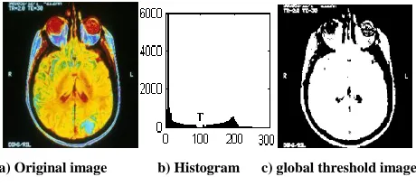 Figure 3 Example of global thresholding for weather cancer MRI brain image 