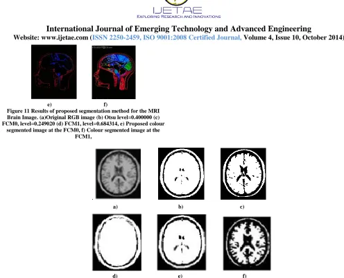 Figure 11 Results of proposed segmentation method for the MRI Brain Image. (a)Original RGB image (b) Otsu level=0.400000 (c) FCM0, level=0.249020 (d) FCM1, level=0.684314, e) Proposed colour 