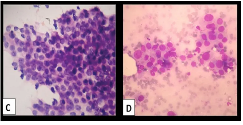 Figure 2 A: FNAC smear of Fibroadenoma of breast showing cohesive ductal cells (Leishman, x400)  B: FNAC 