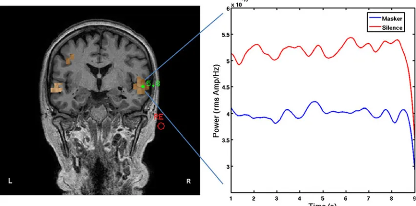 FIG. 3.Aparticipant (TI with hearing loss).(1 Beamformer pseudo-Z image of auditory cortical activation in the delta (1–4 Hz) band during the silence condition for one B For the right hemisphere peak voxel depicted in A, the time course of the normalized power in the delta band–4 Hz) is plotted across the masking and silence epochs.