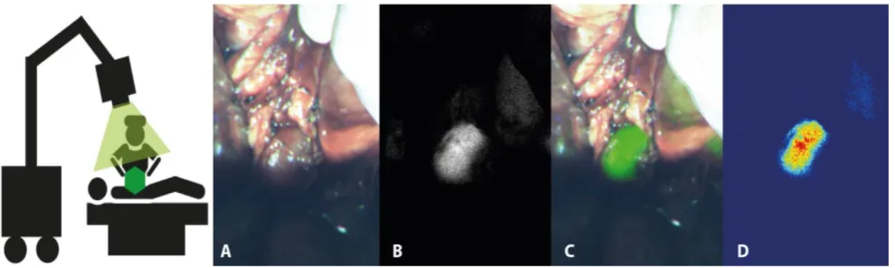 Figure 2. Suggested method of reporting intra-operative imaging results. This includes a bright field image overlay image (A), black-and-white fluorescence image (B), fluorescence (C), and fluorescence heat-map (D)
