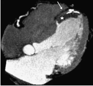 Fig. 3 Apical ventricular remodelling in a patient with myocardialinfarction antecedent