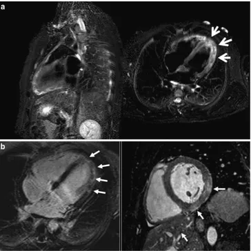 Fig. 10 Contrast-enhanced CTin a patient with LV non-compaction showing deep tra-beculations in the apex of theLV wall that define recessescommunicating with the mainventricular chamber (arrows)