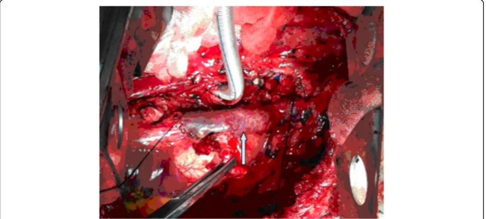 Fig. 2 a Suitable size of autologous pericardium obtained and repeatedly washed with heparin saline