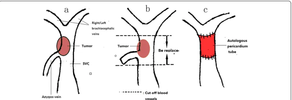 Fig. 4 alower ends of the tumor. Tumor invading the SVC, but not reaching the confluence of the right and left brachiocephalic veins