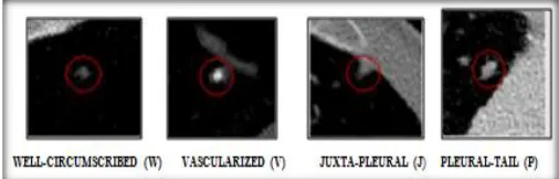 Figure 1: Transaxial Ct images with four types of Lung Nodule 