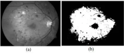 Fig. (a) Original image (b) Severe NPDR 