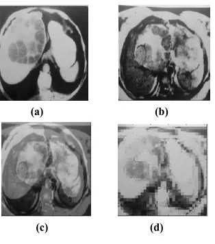 Figure 7: (a) CT image (b) MRI image (c) fused image using          (e) maximum rule (d) pixel averaging (e) minimum rule 