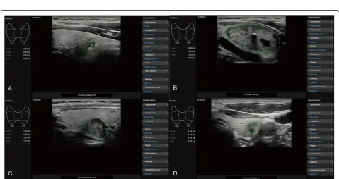 Fig. 1 Grayscale and Doppler US examination of thyroid nodules.and low blood flow; a, b A solid hypoechoic nodule with microcalcifications, a nonparallel pattern c, d A well-defined heterogeneous nodule with macrocalcifications, a parallel pattern and high blood flow; e, f An ovoid toround hypoechoic nodule with low blood flow