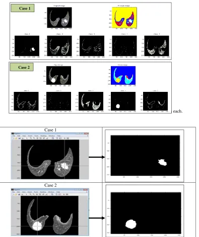 Figure (4): Two cases of patients, classified by utilizing K-means method of five classes each