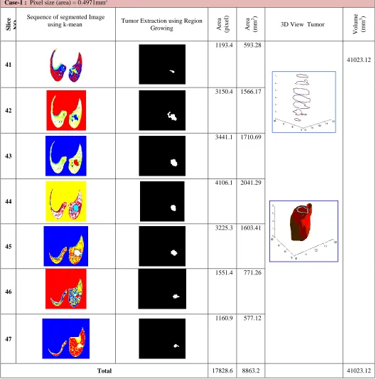 Table I  Region growing method used for tumor extraction, illustrate the 3D tumor reconstruction processes (area and volume of tumor calculation)