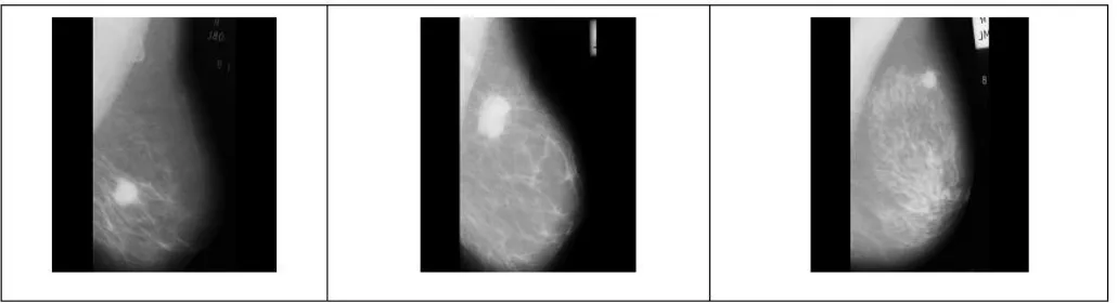 Fig 1 : Original  mammograms with mass  