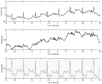 Figure 8-1  ECG Combine with noise (Top Panel), „em‟ Noise middle panel, Extracted ECG with ICA ‎bottom panel