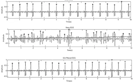 Figure 8-2 Pan Tomkins algorithm for beat detection on a sample of a clean ECG, a noisy ‎ECG (SNR= -6 dB) & filtered ECG using ICA