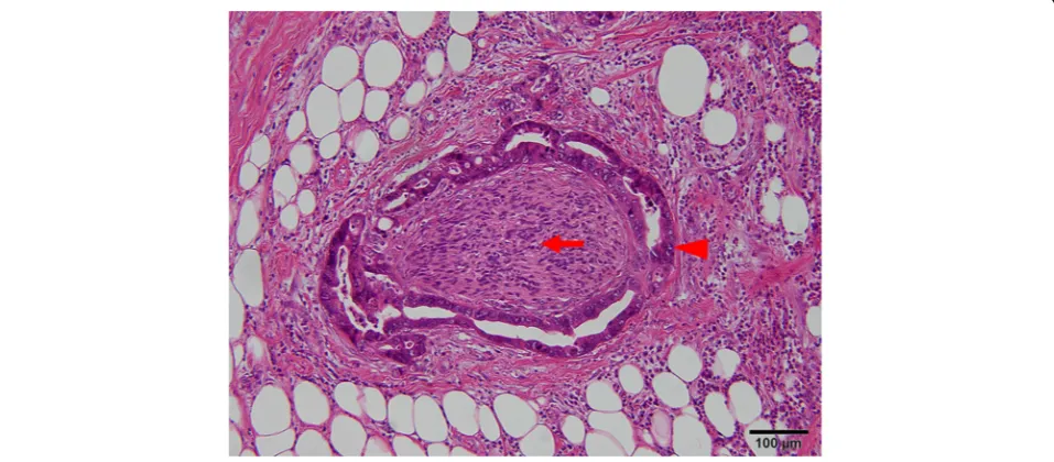 Fig. 1 Representative photomicrographs of perineural invasion adjacent to tumor lesion; arrowhead indicates tumor and arrow indicates nerve