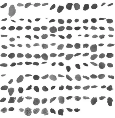 Figure 7. Carcinoma-in-situ image segmented 
