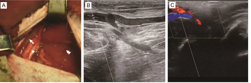 Figure 1. ALN dissection and ultrasound detection of axillary vein in rhesus monkeys. A: A transverse straight inci-sion was made at the right axillary region and the subcutaneous fat and the deep lymphatic tissues around the axil-lary vessels were excised