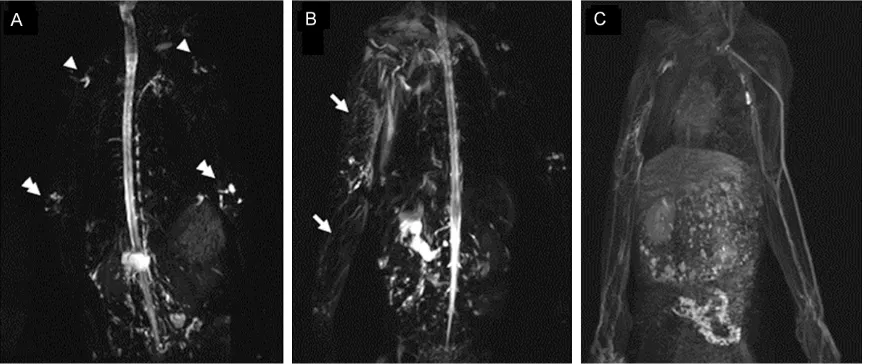 Figure 4. Magnetic resonance imaging (MRI) of lymphedema in the upper limb in rhesus monkeys