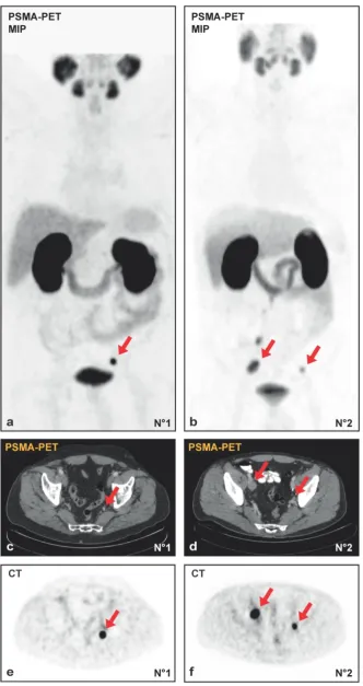 Figure 1. (A, B) Maximum intensity projections (MIP) of PSMA-PET/CT and the transversal PET (E, F) with the corresponding CT (C, D) images from patient N°1 with a single lymph node metastasis (initial PSA 7.43 ng/ml, Gleason-score 3+4 at radical prostatect