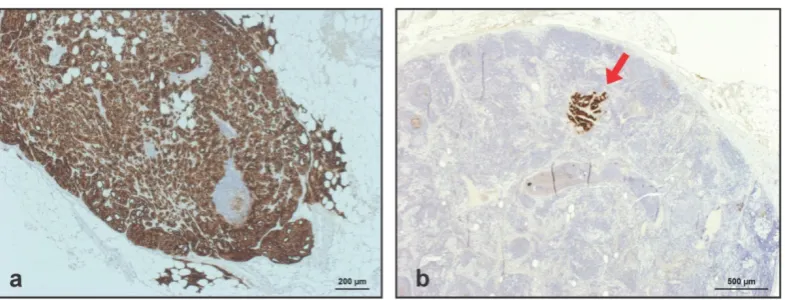 Figure 3. (A) Representative immunohistochemistry (IHC) for prostate-specific membrane antigen (PSMA) in lymph node metastases removed from a true-positive subregions (dark brown)