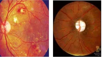 Figure 2 Cases of failure of existing optical disc methods a) Diabetic Image b) Image with multiple bright regions  