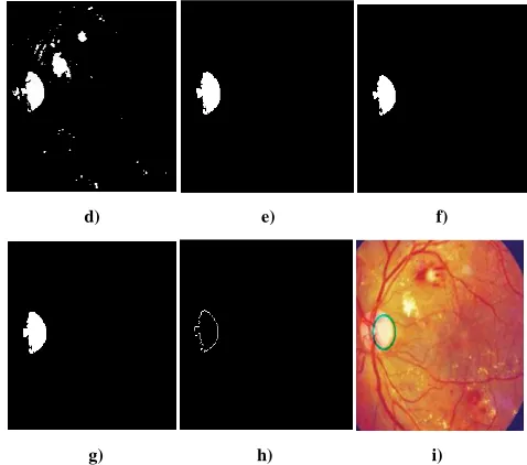 Figure 9 Sequential results of the proposed method for Diabetic image a) Original image b) Gray converted image, c) Bi-histogram equalized image, d) Threshold image, e) Level connected image f) Eroded image, g) Dilated image, h) Extracted disc boundaries, 