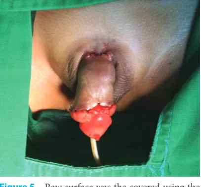 Figure 6  The surgical wound ten days after surgery