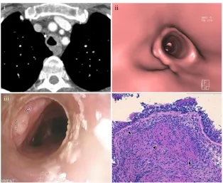 Fig. 20 Relapsing polychondritisCoronal MDCT shows extensivecompromise of the trachea