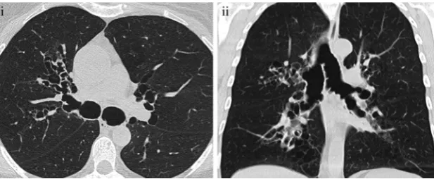 Fig. 15 Acquired tracheobronchomegaly in a 72-year-old patient with abronchiectasis, and tuberculosis sequelae, with a dense band and ahistory of treated tuberculosis