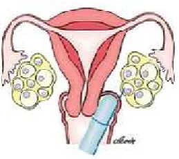 Figure 1.1 Oocyte retrieval