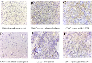 Figure 1.  A. Anti-CD44 expression in stem cells membrane and cytoplasm in GBM, B. Anti-CD133 expression in stem cells membrane in GBM (×100) 