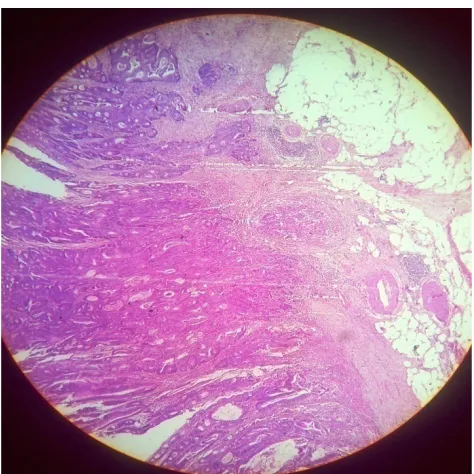 Figure 4.  Specimen of resected growth with segments of the large bowel 