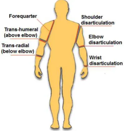 Figure 2. 8: Major level of upper limb amputation (from (72)).   
