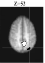 Fig. 4. This ﬁgure presents the areas that show bold activity correlated with top-precuneus, while top-down excitation in the model (maps: (2-4)+(3-1)) was associateddown inhibition in sSoTS (white with black outline) and those where bold activitycorrelate