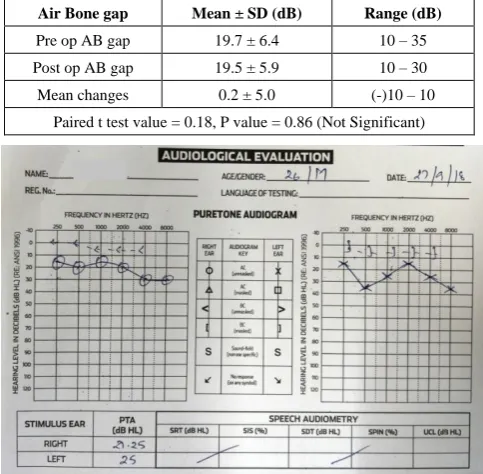Table 2.  Analysis of Pre-operative and Post-operative Air-Bone gap 