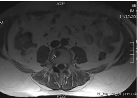 Fig. 4 Metastasis from prostate carcinoma (of T1W axial MR sequence (error due to abnormality outside area ofarrow), missed on top sliceinterest)
