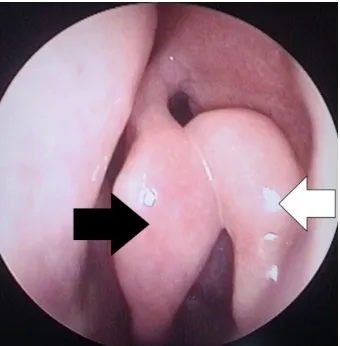 Figure 1.  Endoscopic picture showing accessory middle turbinate [black arrow] and middle turbinate [white arrow] on the right nasal cavity 