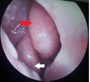 Figure 8.  Coronal CT scans of the paranasal sinuses showed a right bifid inferior turbinate and uncinate process of that side is absent 