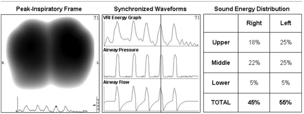 Figure 1Schematic diagram describing the elements of the system.  The patient lies on the acoustic sensor array and the flow sensor is inserted in the Schematic diagram describing the elements of the system