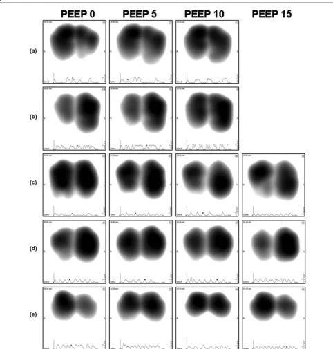 Figure 5Representative frames (or maps) at peak-inspiratory flow obtained from five individual patients at PEEP levels 0, 5, 10 and 15 cmHRepresentative frames (or maps) at peak-inspiratory flow obtained from five individual patients at PEEP levels 0, 5, 1