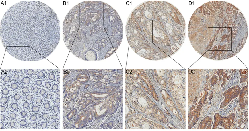 Table 2. Expression of eIF3e in normal mucosa, cancerous tissues and lymph node metastasis tissues