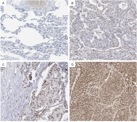Figure 1. Representative Immunohistochemical pictures of SOX8 expression showed in 80 NSCLC samples and 7 normal adjacent tissues: A