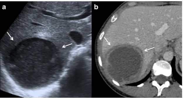 Fig. 2 Amoebic liver abscess. a Axial US image shows a rounded, well-defined hypoechoic lesion with thick walls, located in the right hepaticlobe (arrows)